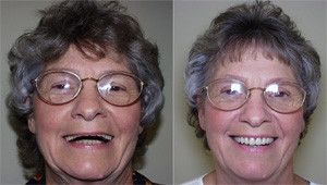 foy-dentures